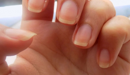 Remèdes Maison pour les Ongles Jaunes